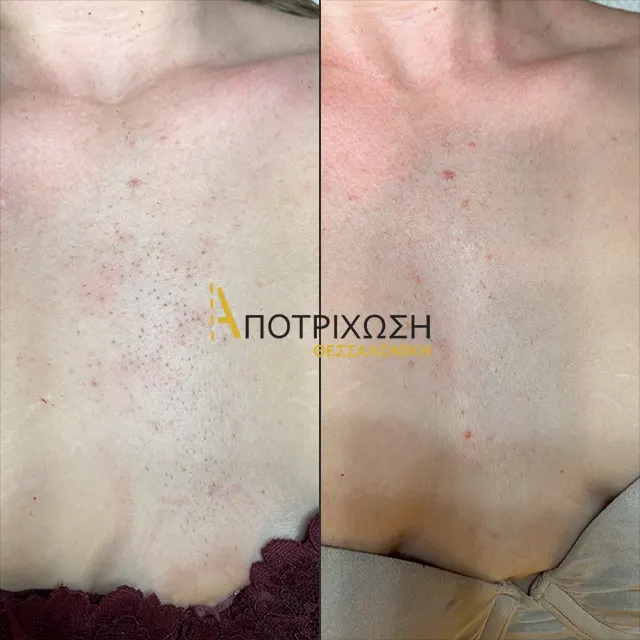 Αποτρίχωση Laser Στήθος Γυναίκες – Πριν & Μετά