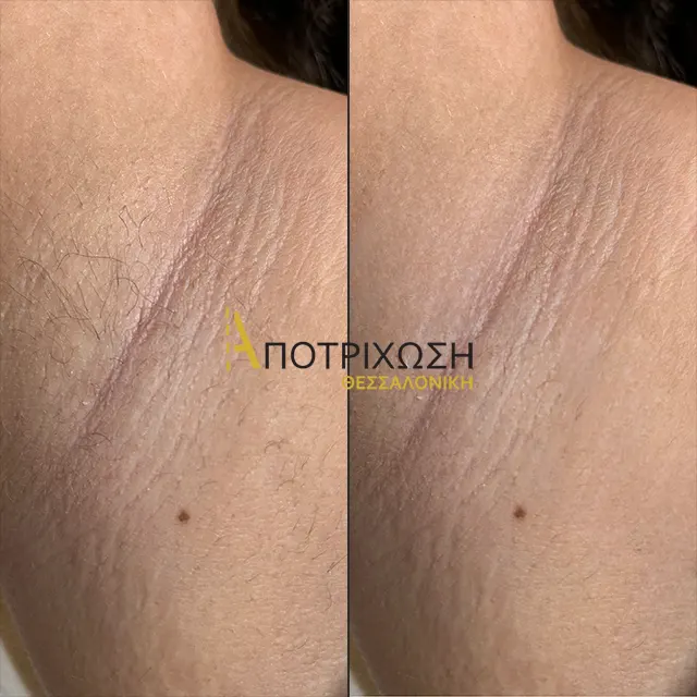 Αποτρίχωση Laser Μασχάλες – Πριν & Μετά