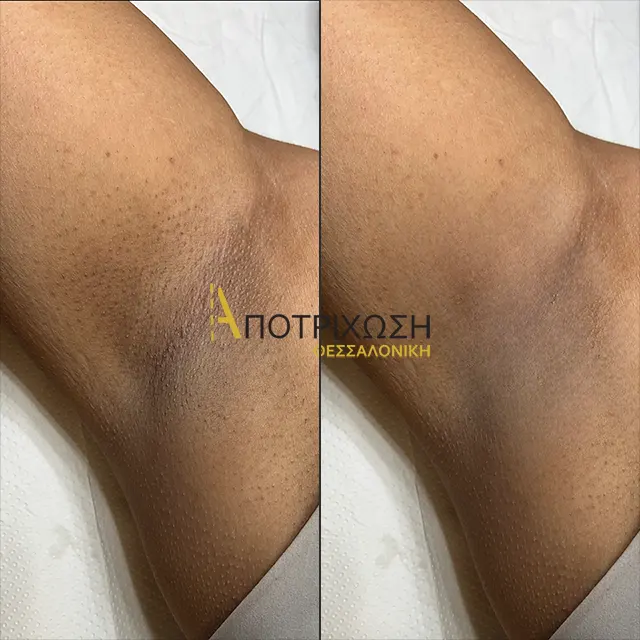 Αποτρίχωση Laser Μασχάλες – Πριν & Μετά