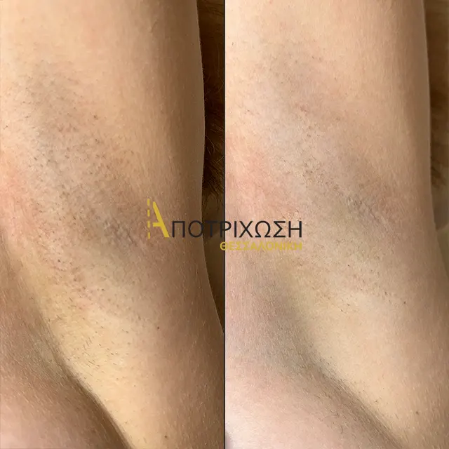 Αποτρίχωση Laser Μασχάλες – Πριν & Μετά