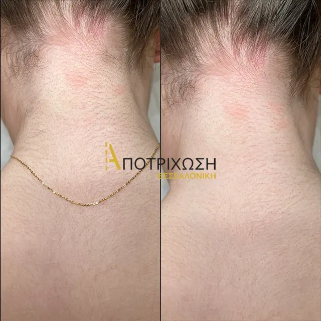 Αποτρίχωση Laser Αυχένας – Πριν & Μετά