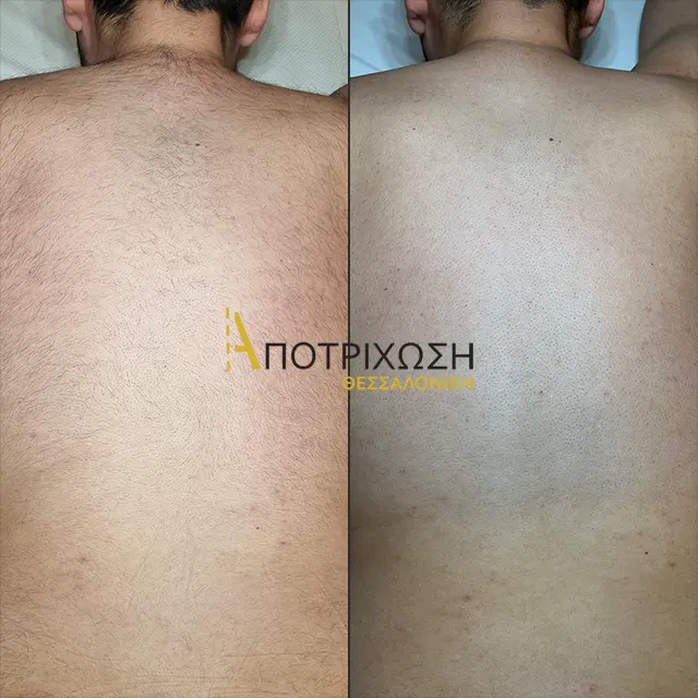 Αποτρίχωση Laser Πλάτη – Πριν & Μετά