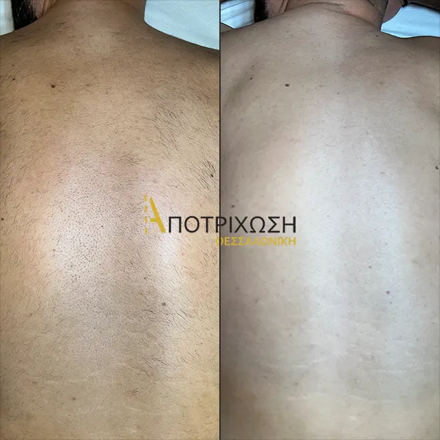 Αποτρίχωση Laser Πλάτη – Πριν & Μετά