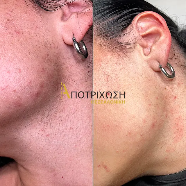 Αποτρίχωση Laser Πρόσωπο – Πριν & Μετά