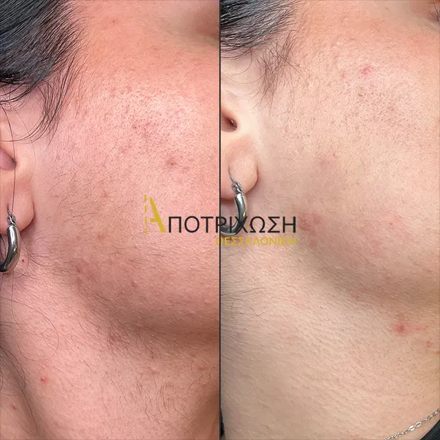 Αποτρίχωση Laser Πρόσωπο – Πριν & Μετά